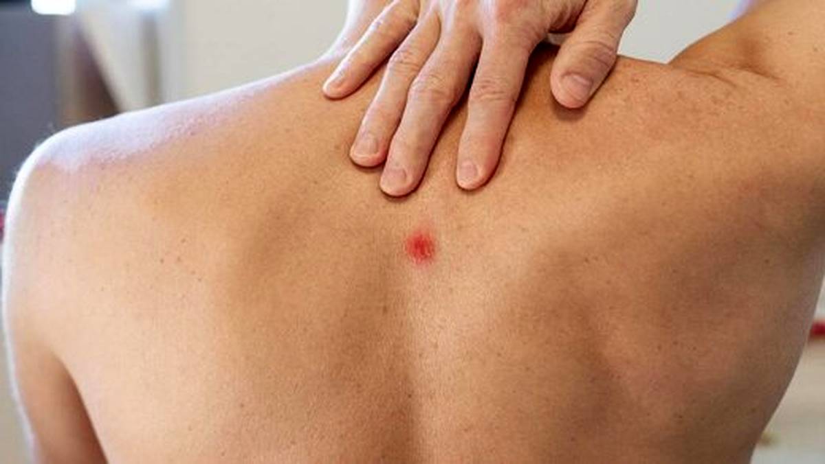 جوش های کمر و حقیقتی عجیب از سلامت شما که فاش می کنند