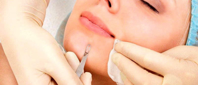 نحوه درمان جوشهای زیر پوستی+ راه حل نحوه درمان جوشهای زیر پوستی+ راه حل